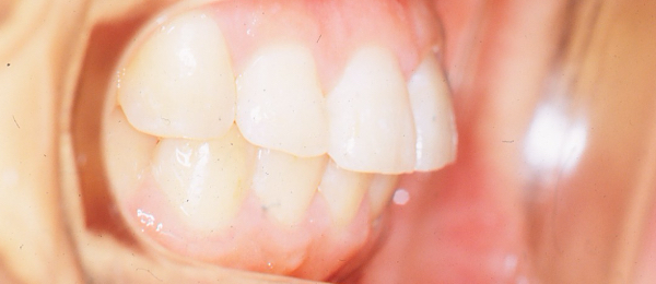 出っ歯(上顎前突)