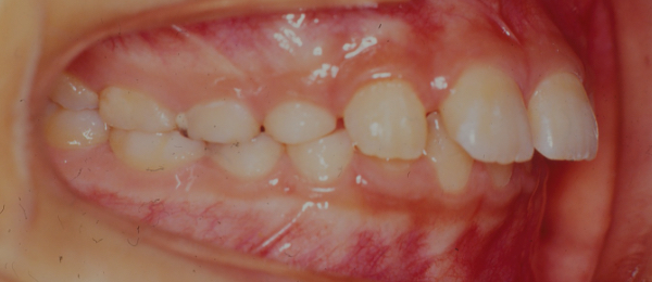 出っ歯(上顎前突)