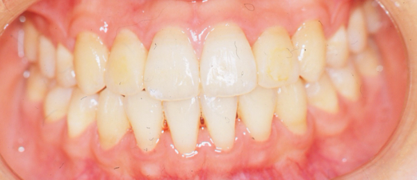 歯がガタガタ(叢生)