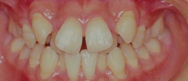 歯がガタガタ(叢生)